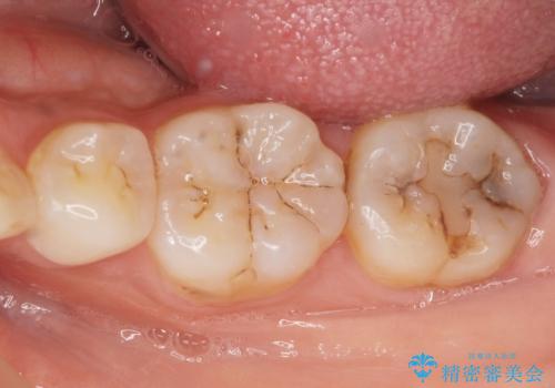 奥歯が黒い セラミッククラウンで綺麗に 30代女性の症例 治療前