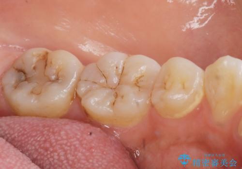 奥歯が黒い セラミッククラウンで綺麗に 30代女性の治療前