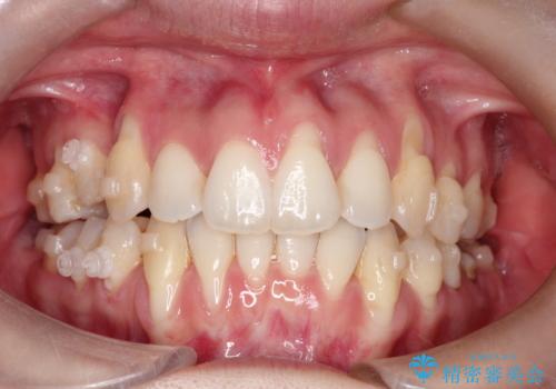 目立つ部位の歯茎がさがってきた　歯茎の移植で元の位置まで回復の治療前