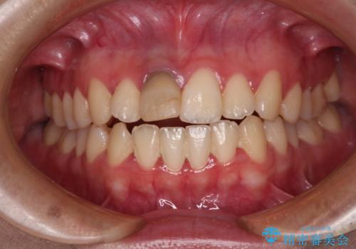 茶色になった前歯 オーダーメイドタイプのオールセラミッククラウンの治療前