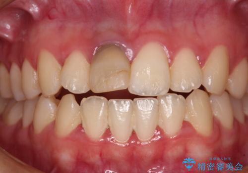 茶色になった前歯 オーダーメイドタイプのオールセラミッククラウンの治療前