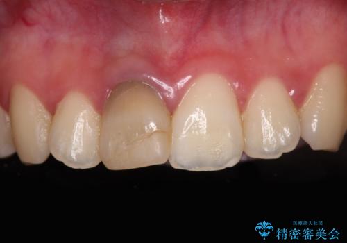 茶色になった前歯 オーダーメイドタイプのオールセラミッククラウンの症例 治療前