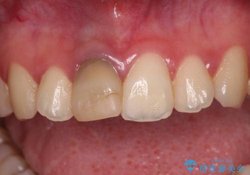 茶色になった前歯 オーダーメイドタイプのオールセラミッククラウンの治療前