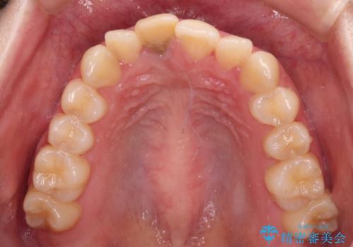 茶色になった前歯 オーダーメイドタイプのオールセラミッククラウンの治療前