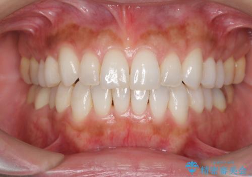 30代女性 前歯のがたつきの症例 治療後
