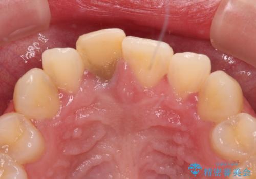 茶色になった前歯 オーダーメイドタイプのオールセラミッククラウンの治療前