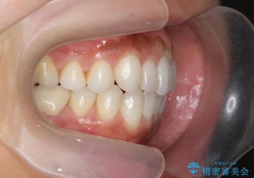 30代女性 前歯のがたつきの治療後
