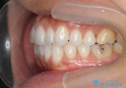 30代女性 前歯のがたつきの治療後