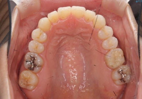 30代女性 前歯のがたつきの治療後
