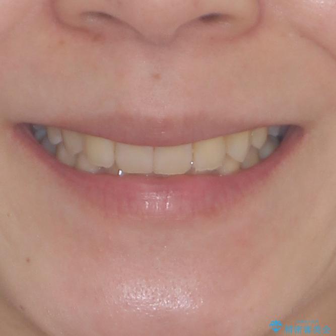 下顎2前歯の欠損 インビザラインによる抜歯矯正の治療後(顔貌)