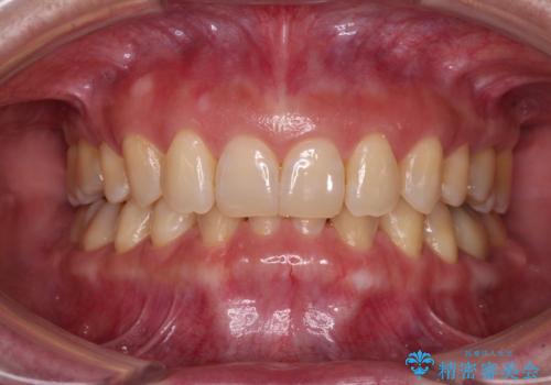 下顎2前歯の欠損　インビザラインによる抜歯矯正の症例 治療後