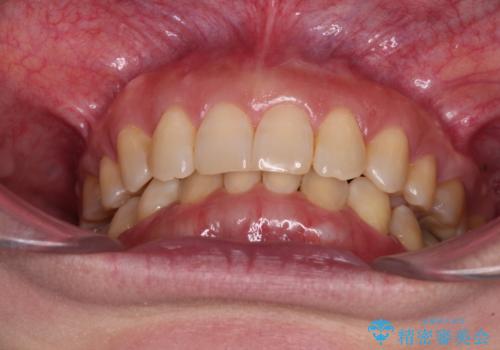 下顎2前歯の欠損 インビザラインによる抜歯矯正の治療後