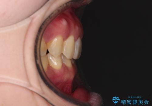 下顎2前歯の欠損 インビザラインによる抜歯矯正の治療後