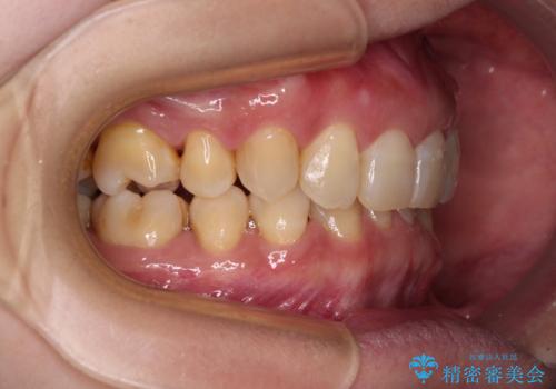 下顎2前歯の欠損 インビザラインによる抜歯矯正の治療後