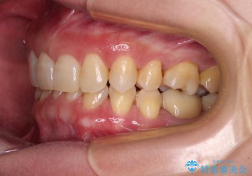 下顎2前歯の欠損　インビザラインによる抜歯矯正の治療後