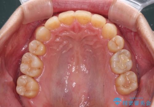 下顎2前歯の欠損 インビザラインによる抜歯矯正の治療後
