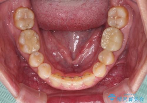 下顎2前歯の欠損 インビザラインによる抜歯矯正の治療後