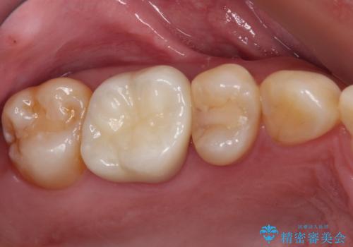 奥歯がしみる むし歯と知覚過敏の補綴治療 の治療後