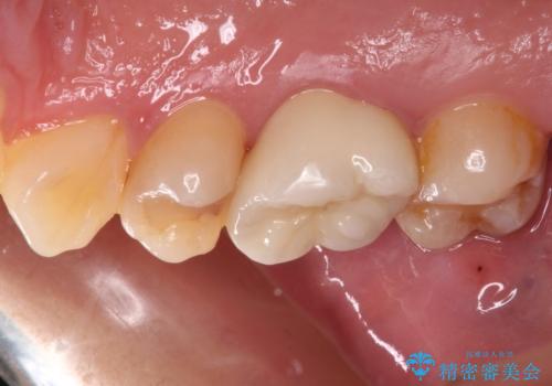 奥歯がしみる むし歯と知覚過敏の補綴治療 の治療後