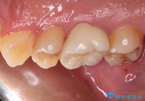 奥歯がしみる　むし歯と知覚過敏の補綴治療　の治療後