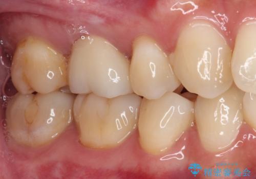 奥歯がしみる むし歯と知覚過敏の補綴治療 の治療後