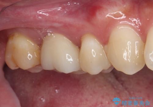 奥歯がしみる むし歯と知覚過敏の補綴治療 の治療後