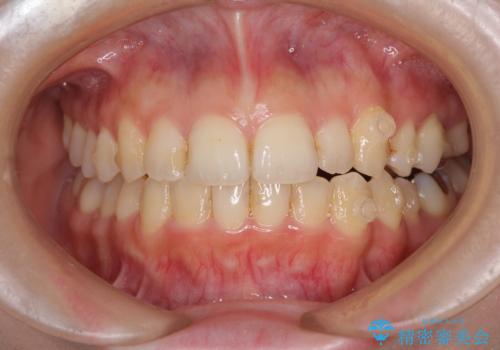 顕著な八重歯をインビザラインで治せるところまで改善の治療中