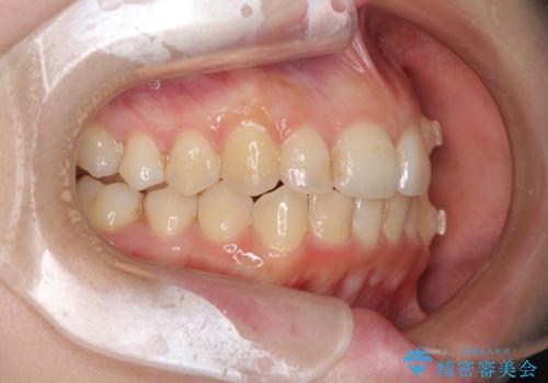 顕著な八重歯をインビザラインで治せるところまで改善の治療中
