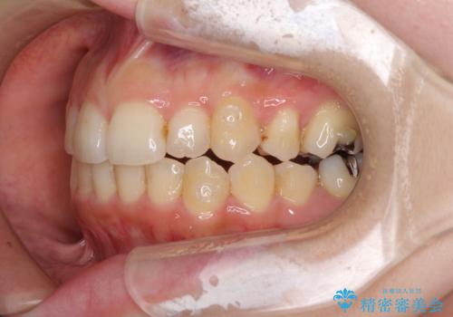顕著な八重歯をインビザラインで治せるところまで改善の治療中