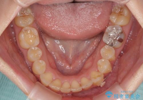 顕著な八重歯をインビザラインで治せるところまで改善の治療中