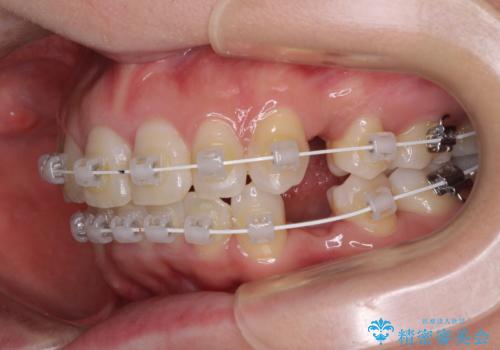 インビザラインが続けられない ワイヤー装置による抜歯矯正の治療中