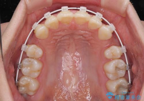 インビザラインが続けられない ワイヤー装置による抜歯矯正の治療中