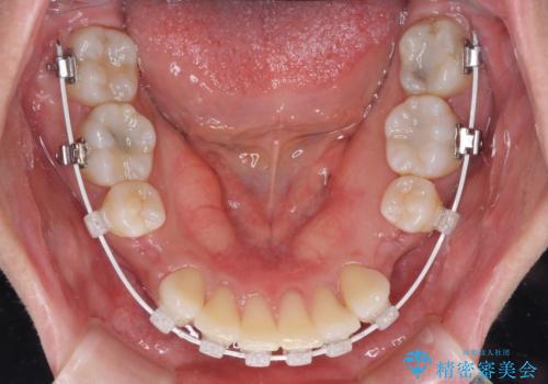 インビザラインが続けられない ワイヤー装置による抜歯矯正の治療中