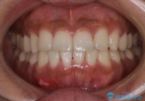 光加速矯正装置(オルソパルス)を用いた短期間での矯正治療の症例 治療後