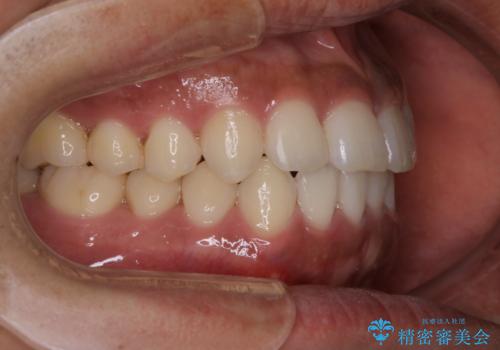 光加速矯正装置(オルソパルス)を用いた短期間での矯正治療の治療後