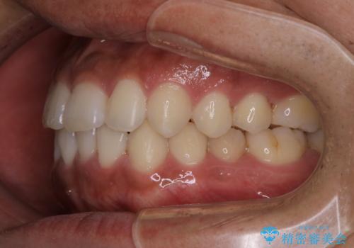 光加速矯正装置(オルソパルス)を用いた短期間での矯正治療の治療後