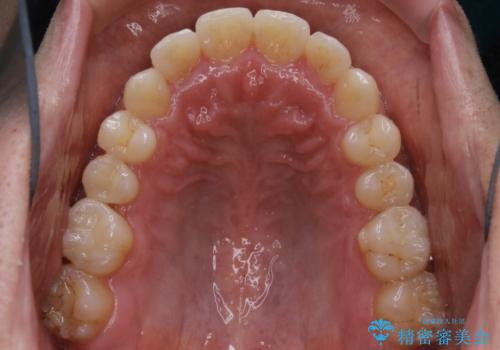 光加速矯正装置(オルソパルス)を用いた短期間での矯正治療の治療後