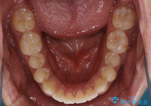 光加速矯正装置(オルソパルス)を用いた短期間での矯正治療の治療後