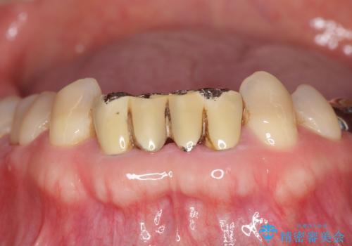 下の前歯のブリッジ 保険治療のやり替えの治療前