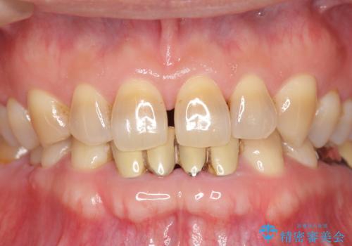 下の前歯のブリッジ 保険治療のやり替えの治療前