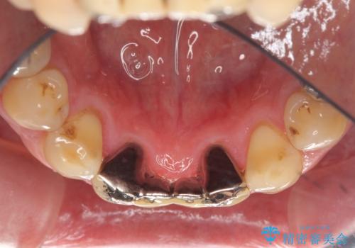 下の前歯のブリッジ 保険治療のやり替えの治療前