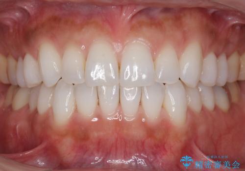 30代女性 前歯のがたつきの治療中