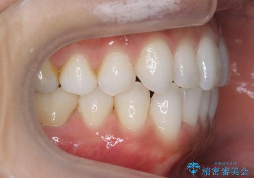 30代女性 前歯のがたつきの治療中