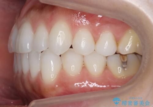30代女性 前歯のがたつきの治療中
