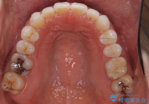 30代女性 前歯のがたつきの治療中