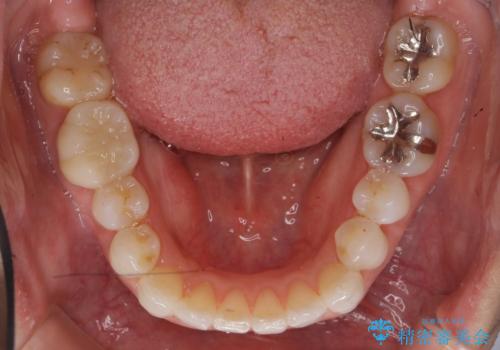 30代女性 前歯のがたつきの治療中