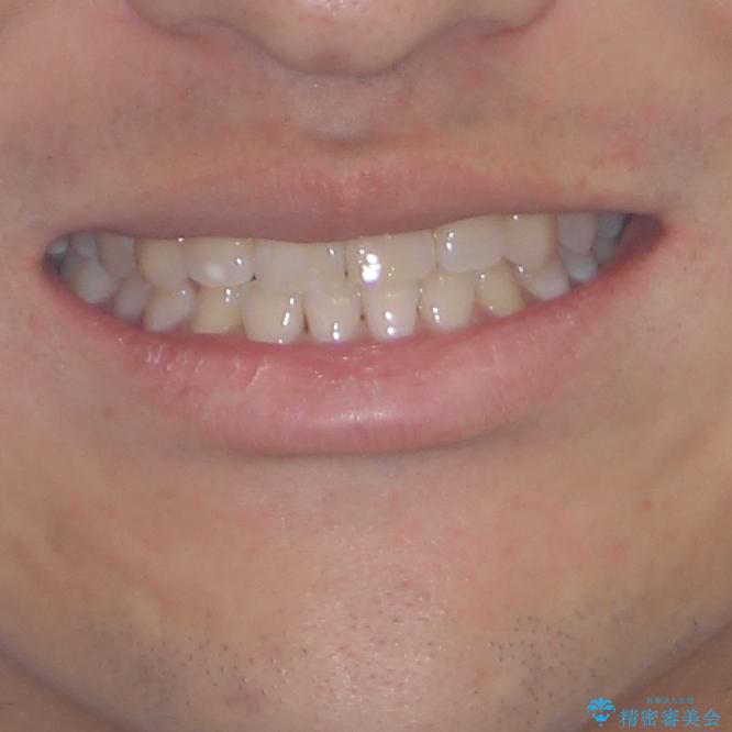 隙間の空いた前歯を治したい 上顎の部分矯正の治療後(顔貌)
