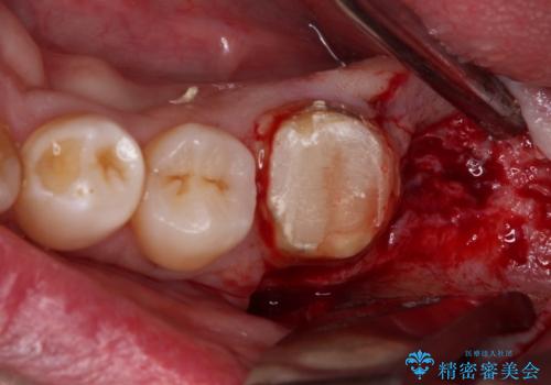 抜歯が必要な奥歯　ストローマン・インプラント補綴治療の治療前