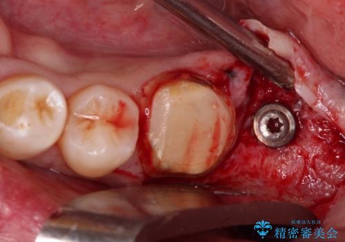 抜歯が必要な奥歯　ストローマン・インプラント補綴治療の治療中