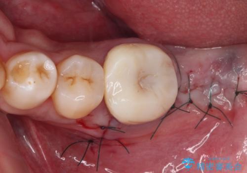 抜歯が必要な奥歯　ストローマン・インプラント補綴治療の治療後
